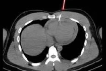 Cứu sống nam thanh niên 21 tuổi bị thủng tim do máy bắn đinh