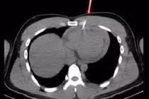 Cứu sống nam thanh niên 21 tuổi bị thủng tim do máy bắn đinh
