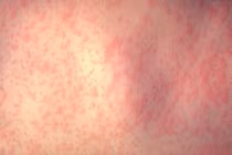 2 trẻ mới mắc bệnh sởi ở TPHCM đều chưa tiêm vắc xin