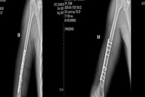 Nam thanh niên 21 tuổi gãy xương cánh tay khi chơi vật tay