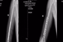 Nam thanh niên 21 tuổi gãy xương cánh tay khi chơi vật tay