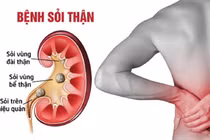 Thói quen xấu của dân văn phòng dễ gây sỏi thận