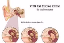 Biến chứng nguy hiểm của viêm tai xương chũm mãn tính