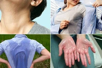 Cơ thể đổ mồ hôi bất thường đi khám ngay coi chừng bệnh nặng