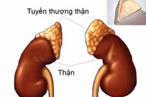 Lạm dụng thuốc giảm đau, bệnh nhân suy tuyến thượng thận