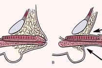 Bác sĩ chia sẻ cách điều trị vùi dương vật bẩm sinh ở trẻ