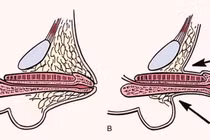 Bác sĩ chia sẻ cách điều trị vùi dương vật bẩm sinh ở trẻ