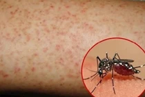 Việt Nam sắp có vắc xin ngừa sốt xuất huyết