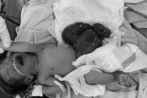 Bé trai sinh non 2,4 kg có nội tạng nằm ngoài ổ bụng