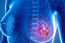 Thời điểm vàng để tầm soát ung thư vú