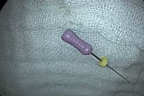 Bé 5 tuổi nuốt cả cây kim dài 2,5 cm vào bụng