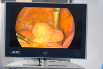 Bóc tách u bì buồng trứng có xương, tóc cho bệnh nhân 35 tuổi