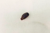 Bé 14 tháng tuổi bị biến chứng phổi do hóc hạt mãng cầu