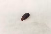 Bé 14 tháng tuổi bị biến chứng phổi do hóc hạt mãng cầu