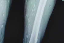 Sán chi chít từ chân tới não vì... sở thích ăn đồ sống