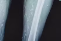 Sán chi chít từ chân tới não vì... sở thích ăn đồ sống