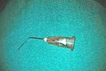 Bé trai 10 tuổi nuốt kim tiêm vào dạ dày khi đi chữa răng