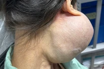 Người phụ nữ suýt mất mạng vì khối u “khổng lồ” trên mặt