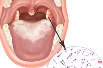 Phân biệt bệnh bạch hầu họng với các chứng viêm họng, amidan