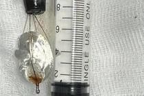 Bé trai 11 tuổi nuốt nắp lon nước ngọt vào bụng