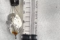 Bé trai 11 tuổi nuốt nắp lon nước ngọt vào bụng