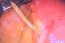 Người phụ nữ 61 tuổi bị xương cá xuyên thủng thành ruột non