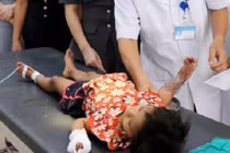 Bé gái ngã vào chậu nước sôi bỏng nặng, cách sơ cứu bỏng nhiệt