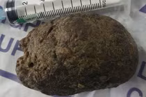 Tắc ruột sau khi ăn 3 quả hồng ngâm phải nhập viện cấp cứu