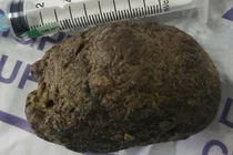 Tắc ruột sau khi ăn 3 quả hồng ngâm phải nhập viện cấp cứu