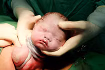 Hy hữu bé gái chào đời với 9 vòng dây rốn quấn cổ