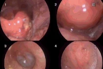 Người đàn ông phù nề hạ họng vì tự xử lý hóc xương cá