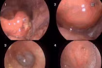 Người đàn ông phù nề hạ họng vì tự xử lý hóc xương cá