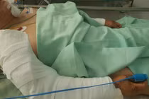 Người phụ nữ bị chó pitbull cắn đứt tai, chấn thương nguy kịch