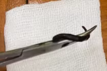 Gắp con vắt dài 5cm trong mũi bé gái 32 tháng tuổi