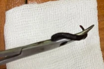 Gắp con vắt dài 5cm trong mũi bé gái 32 tháng tuổi