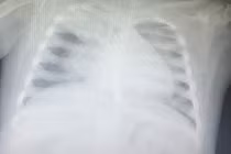 Cứu sống bé gái 3 tuổi nhiễm cúm A suy hô hấp nặng