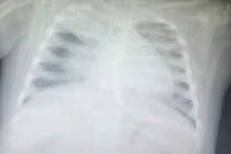 Cứu sống bé gái 3 tuổi nhiễm cúm A suy hô hấp nặng