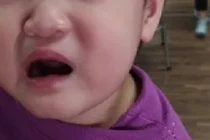 Bé 2 tuổi méo miệng, liệt dây thần kinh số 7 do trời rét đậm