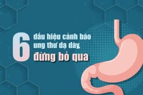 6 dấu hiệu cảnh báo ung thư dạ dày