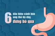 6 dấu hiệu cảnh báo ung thư dạ dày