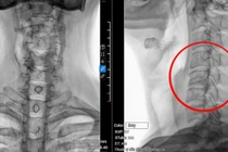 Hỏng ba đốt sống cổ do... cúi đầu dùng điện thoại 8 giờ/ ngày