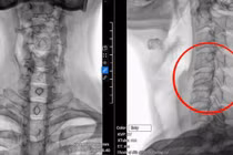 Hỏng ba đốt sống cổ do... cúi đầu dùng điện thoại 8 giờ/ ngày