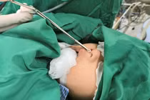 Hiếm gặp, bé trai 4 tuổi có răng mọc ở mũi 