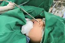 Hiếm gặp, bé trai 4 tuổi có răng mọc ở mũi 