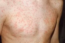 Cảnh báo bùng phát bệnh sởi, bác sĩ chỉ cách phòng ngừa