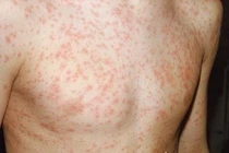 Cảnh báo bùng phát bệnh sởi, bác sĩ chỉ cách phòng ngừa