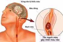 Biện pháp phòng ngừa bệnh thiểu năng tuần hoàn não gây tai biến