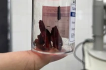 Mảnh gỗ dài nằm trong hốc mắt nam thanh niên suốt 1 tháng