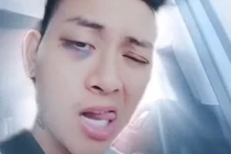 Hoài Lâm lộ clip “như ngáo đá“, mắt thâm tím, quản lý lên tiếng