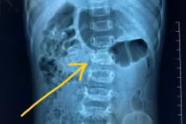 Trẻ gù cột sống thắt lưng, nguyên nhân khiến cha mẹ bất ngờ